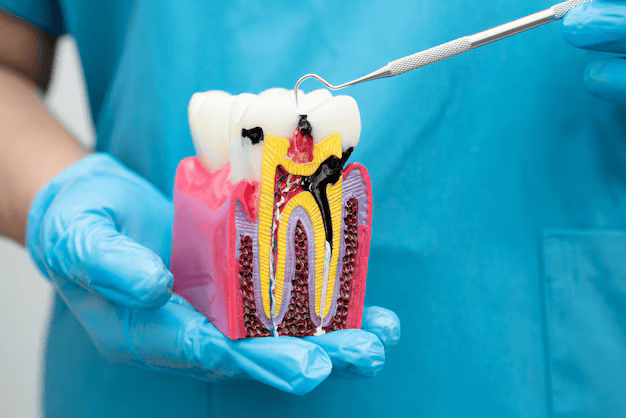 Root Canal Treatment
